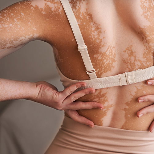 Rücken einer Frau mit Vitiligo